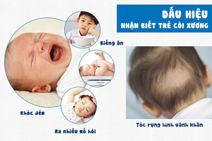 Dấu hiệu trẻ bị suy dinh dưỡng còi xương