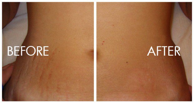 Hình ảnh trước và sau khi dùng tỏi đen trị rạn da sau sinh nở