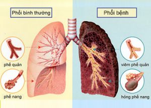 Bệnh viêm khớp dạng thấp gây mắc phải các bệnh phổi mạn tính  