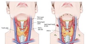 dấu hiệu ung thư vòm họng