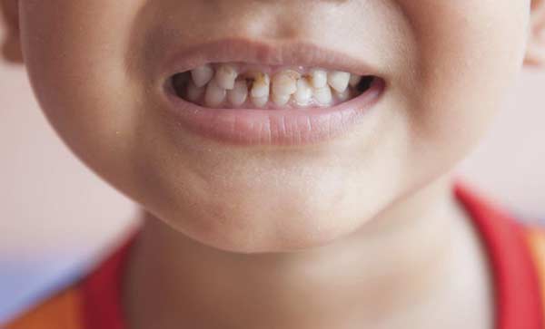 Sún răng ở trẻ là vì sao