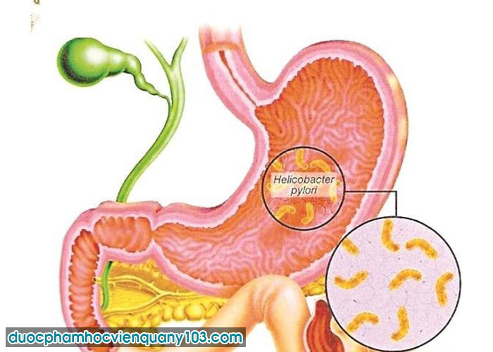 Nguyên Nhân Dẫn Đến Bệnh Viêm Dạ Dày - Tá Tràng Hiện Nay