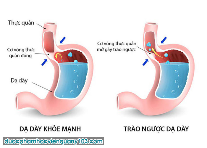 Trào Ngược Dạ Dày