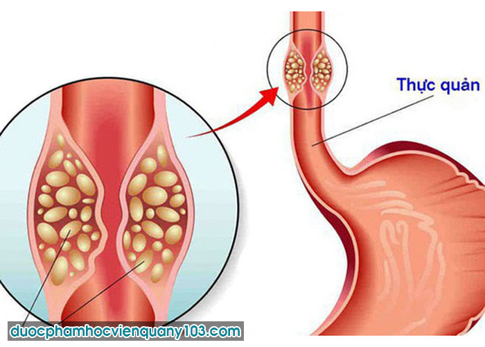 Vì Sao Trào Ngược Dạ Dày Thực Quản Hay Bị Tái Phát?