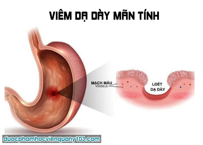 Viêm Dạ Dày Mãn Tính