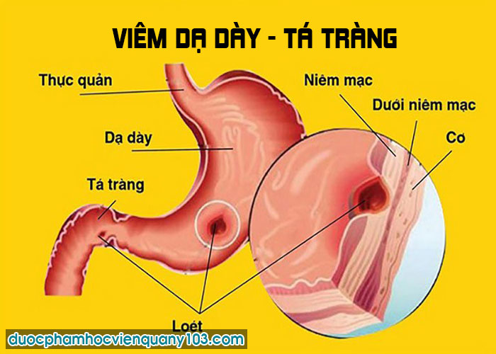 Viêm Dạ Dày - Tá Tràng?