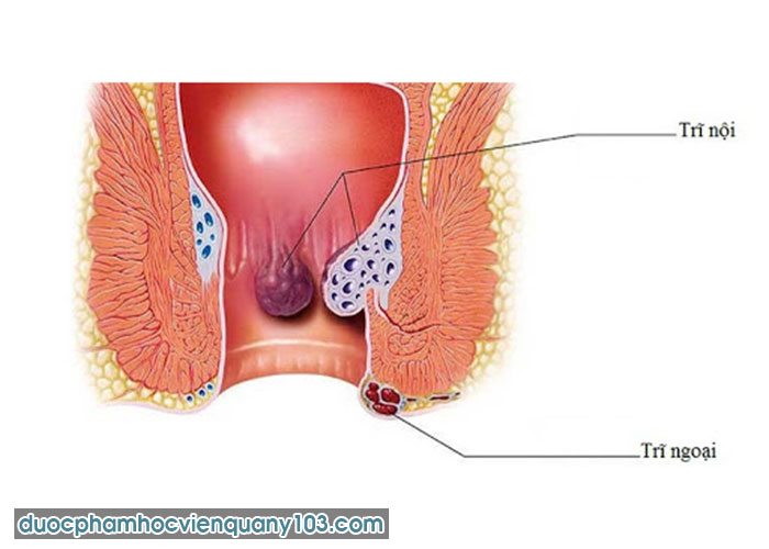 Nguyên Nhân Gây Ra Tắc Mạch Trĩ Nội