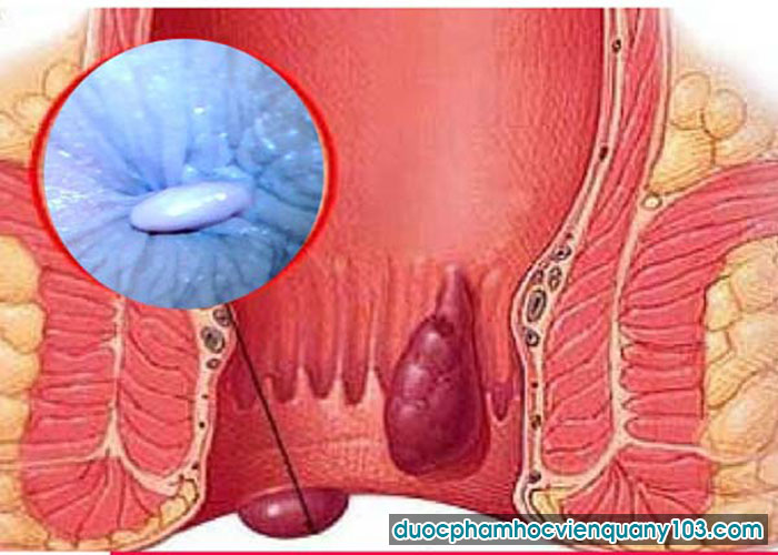 Tắc Mạch Trĩ Là Gì