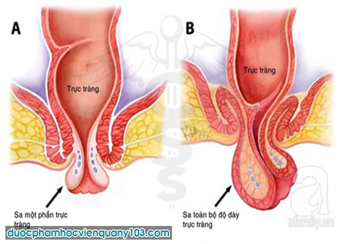 Những Dấu Hiệu Dễ Nhận Biết Nhất Của Bệnh Trĩ Sau Sinh