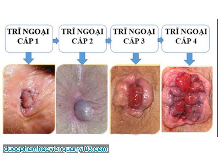 Trĩ Ngoại Ở Trẻ Em